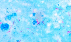 Acid fast staining